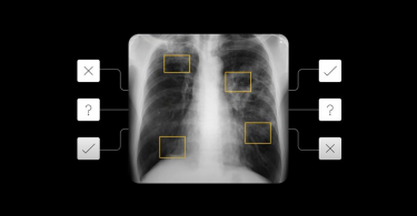 Cara Tools AI Google Mendeteksi Tuberkolosis