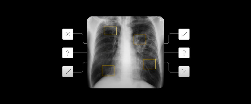 Cara Tools AI Google Mendeteksi Tuberkolosis